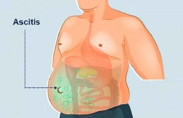 Що таке асцит: причини, симптоми та методи лікування захворювання