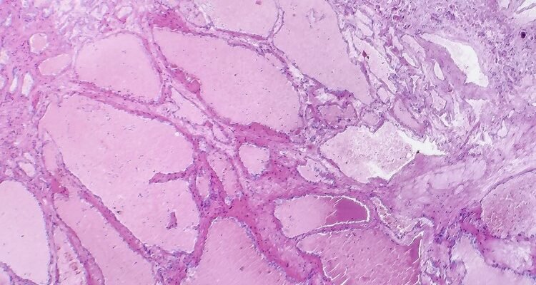 Гемангіома: що це таке, симптоми, діагностика та лікування