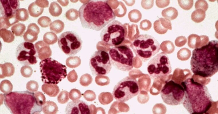 Лейкемія: Причини, симптоми та сучасні методи лікування хвороби