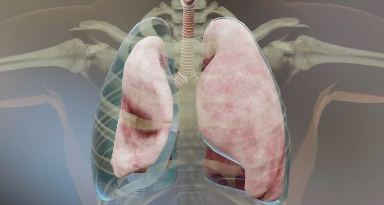 Пневмоторакс: симптоми, причини та методи лікування цього стану