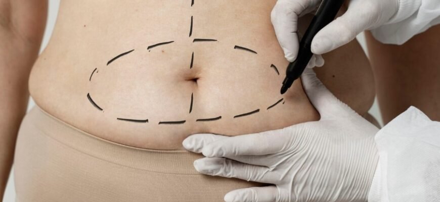 Абдомінопластика: що це таке та як відбувається процедура корекції живота?
