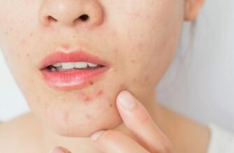 Що таке акне: причини, симптоми та методи ефективного лікування