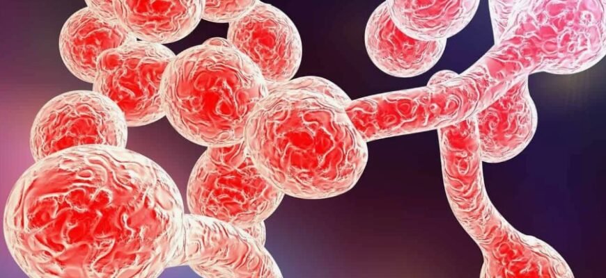 Відкрийте для себе кандидоз: причини, симптоми та ефективне лікування