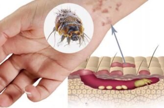 Що таке короста: симптоми, причини та методи ефективного лікування