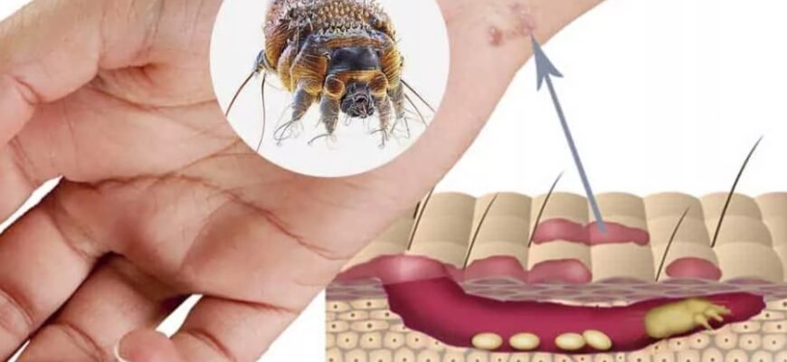 Що таке короста: симптоми, причини та методи ефективного лікування