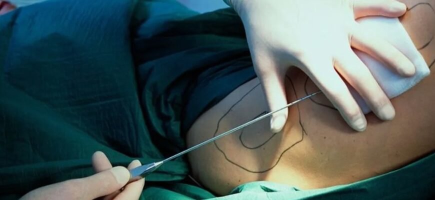 Ліпосакція: що це, як вона працює та які результати очікувати? Ліпосакція: що це, як вона працює та які результати очікувати?