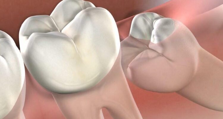 Зуби мудрості: Що це таке та чому вони викликають стільки проблем?