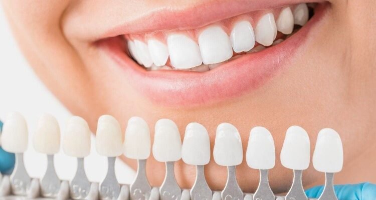 Вініри: Обираємо красиву та здорову усмішку—для кого вони ідеальні?